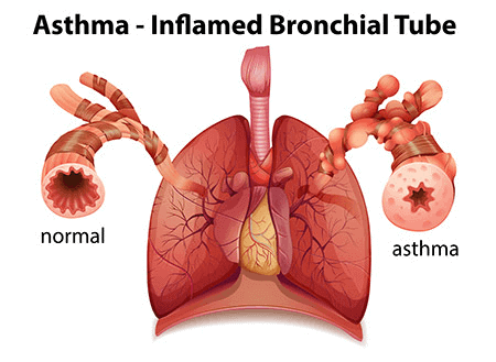Asthma diagnosis and treatment